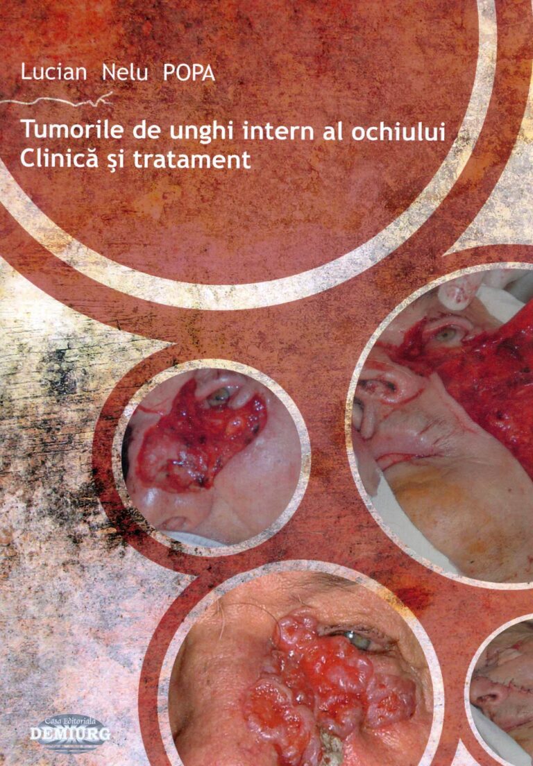Tumorile de unghi intern al ochiului. Clinica si tratament